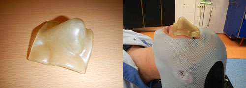 3D печатный фильтр делает лучевую терапию более действенной