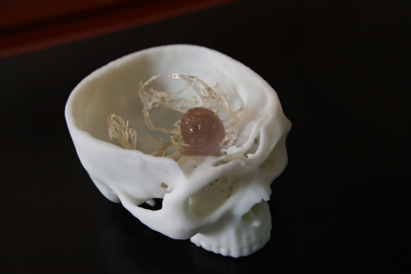 Поликлиника использовала 3D печать для оказания помощи при удалении опухоли основания черепа