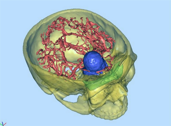 Поликлиника использовала 3D печать для оказания помощи при удалении опухоли основания черепа