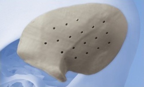 Китайские докторы сейчас могут вернуть череп пациента при помощи 3D печатного имплантата