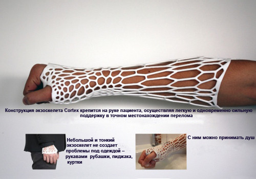 3D печатный экзоскелет Cortex — подмена гипсовой повязки
