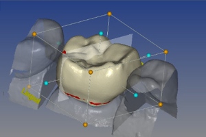 Шаг вперед в стоматологии при помощи 3D печати