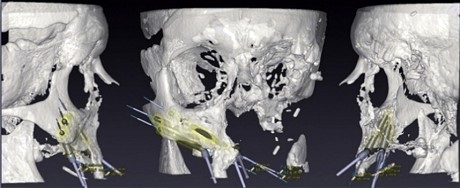 Докторы сделали новое 3D печатное лицо пострадавшему от рака