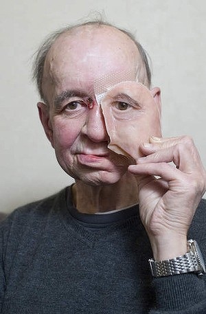 Докторы сделали новое 3D печатное лицо пострадавшему от рака