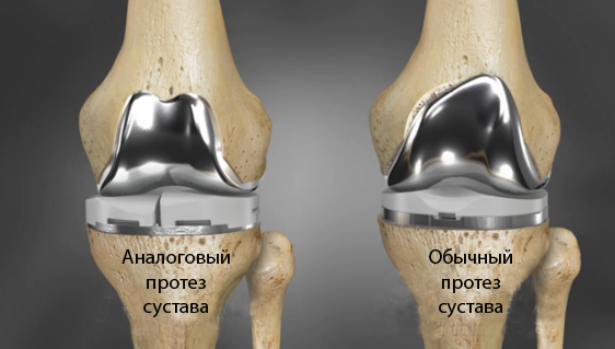 3D печать и революция в операциях на коленных суставах