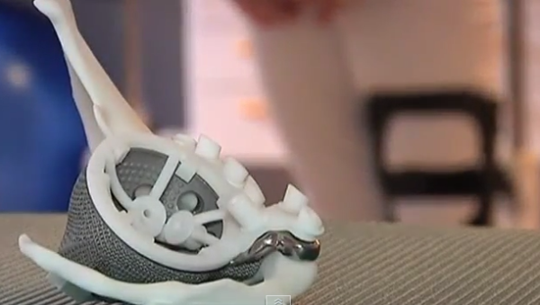 3D печатное бедро возвратило ребенка на ноги