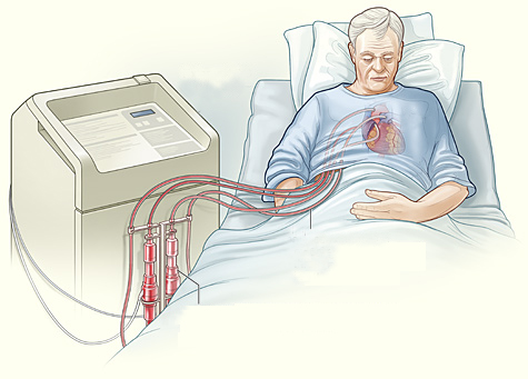 3D-печатный электрический смарт-насос поддерживает работу и жизнедеятельность сердца пациента