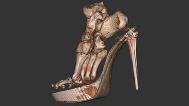 3D  сканирование показало, как высочайшие каблуки оказывают влияние на ступни